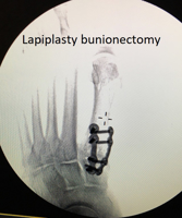 Lapidus Bunionectomy – tips to return to early weight bearing